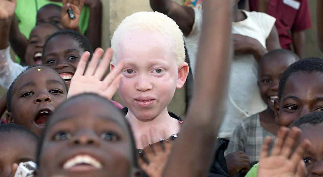 Albinos en África: brujería y negocio | #JovenesHOY - Blogs hoy.es