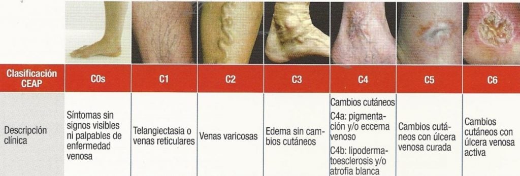 Las Varices, esa pesadez en las piernas. | Salud para todos - Blogs hoy.es